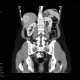 Focal nodular hyperplasia, liver: CT - Computed tomography